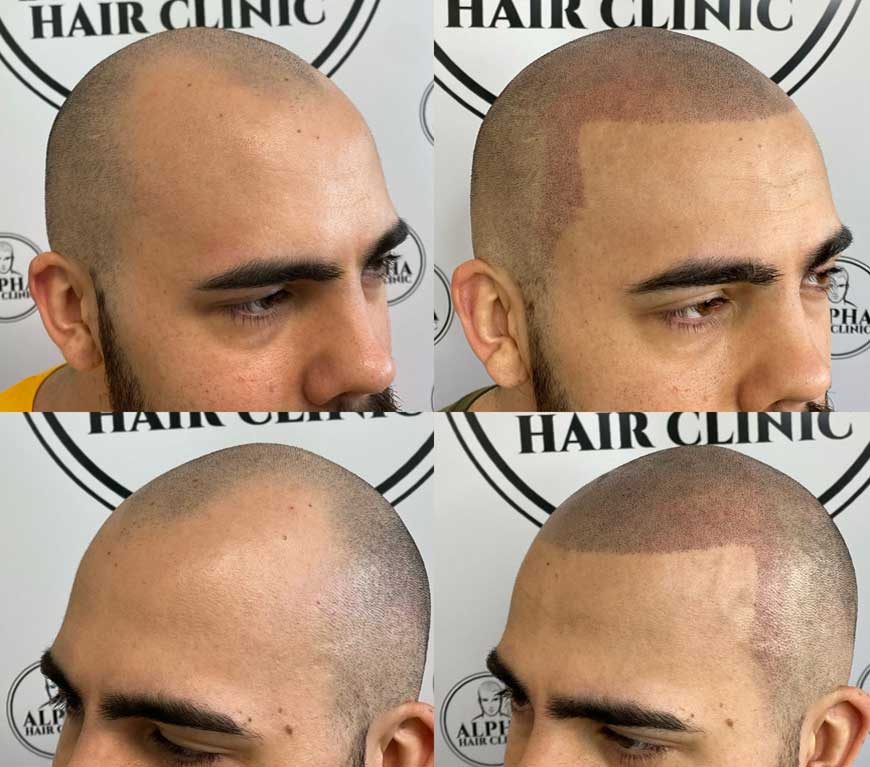 Before and After Scalp Micropigmentation | Alpha Hair Clinic
