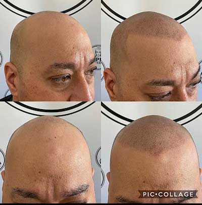 Before and After Scalp Micropigmentation | Alpha Hair Clinic